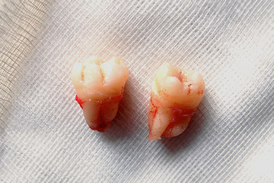 wisdom-teeth