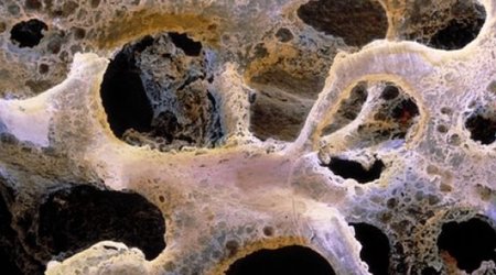 Protein could bring hope to brittle bone disease