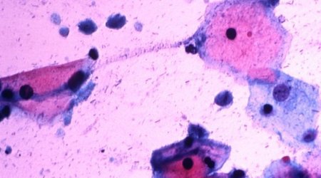 Prostate cancer 'may be a sexually transmitted disease'