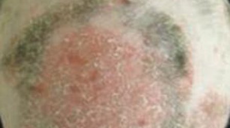 Scientists successfully use arthritis drug to regrow completely bald man's hair - PHOTO