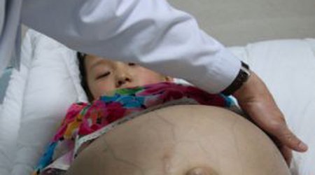Girl has a watermelon-sized tumour removed from her ovaries - PHOTO