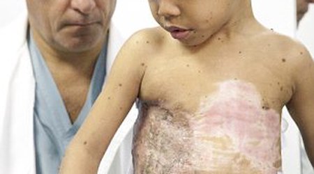 Boy had giant 'turtle shell' mutation removed from his back - PHOTO