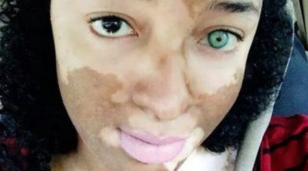 Girl born ‘with a permanent tattoo of a dog kissing a bunny’ - PHOTO