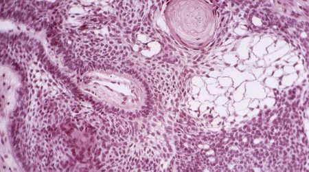 Cancer-killing stem cells engineered in lab