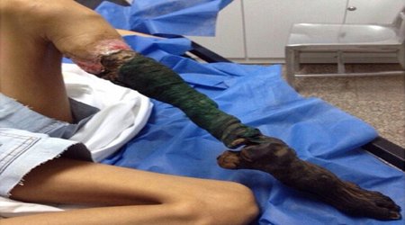 Girl's leg shrivels and turns BLACK - VIDEO