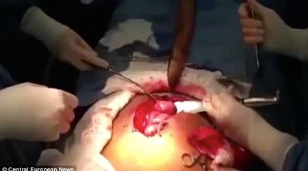 Huge LIVE fish is removed from a man's intestine - PHOTO+VIDEO