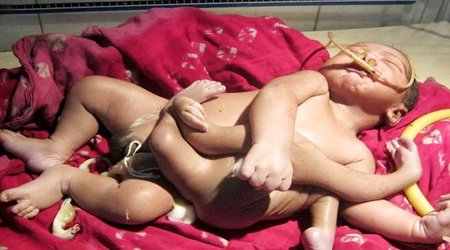 Baby born with four arms and four legs - VIDEO