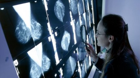Cholesterol 'fuels' breast cancer