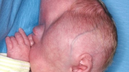 Baby with misshapen head undergoes pioneering surgery - PHOTO