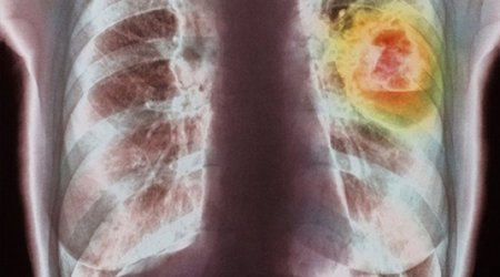 Global cancer cases reach 14 million, WHO says