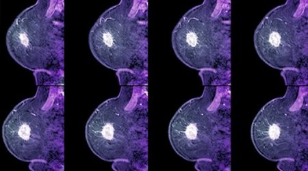 Drug 'halves' breast cancer risk