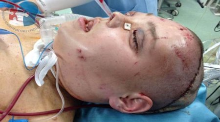 Woman who could not eat or talk gets full face transplant