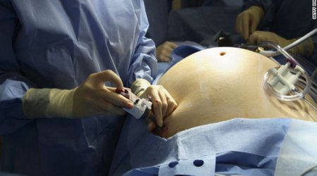 Bariatric surgery isn't 'one size fits all'