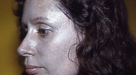 'Nose drops made my skin to turn silver' - PHOTO