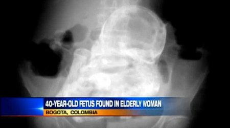 Woman with stomach pain is found to have a 40-year-old fetus inside her