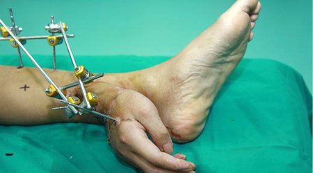 Man has severed hand successfully reattached after... - PHOTO