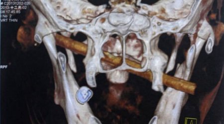 Woman has five-inch bamboo stick lodged in her face - PHOTO