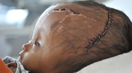 2-year-old has successful surgery to reduce huge swelling - PHOTO