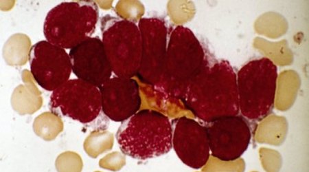 Antibody machinery can misfire and cause leukaemia