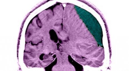 Brain blow leaves life-long dangers