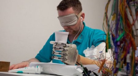 Bionic hand makes patient the first amputee in the world
