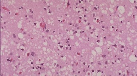 18 may have been exposed to incurable disease
