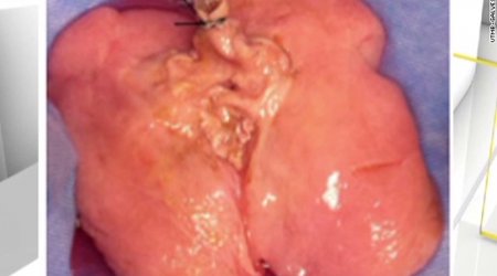 Human lung made in lab for first time