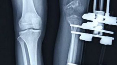 Woman, 21, has surgery to extend her stunted left leg - PHOTO