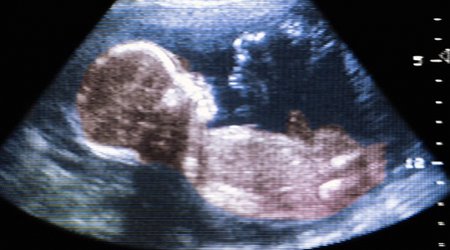 Autism may be caused by environmental factors