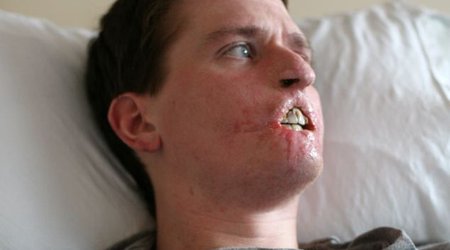 Man loses three limbs and half his face - PHOTO