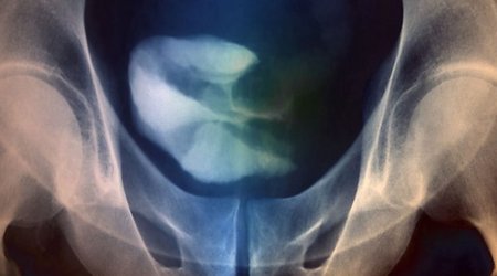 Bladder cancer: 'Exciting' drug breakthrough