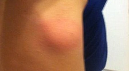 Boy's fatal spider bite taken - PHOTO