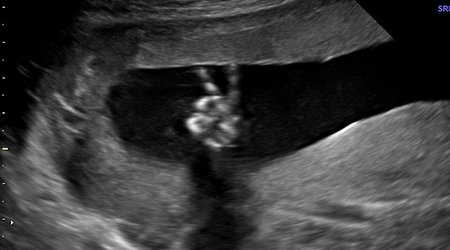 The baby pictured doing a victory V-sign in the womb