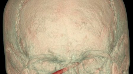 Miracle as gardener with a three inch NAIL stuck in his eye escapes with no sight damage