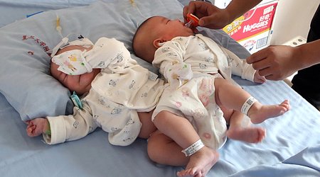 Doctors separate conjoined twins with help of 3D printer
