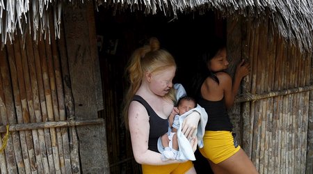 Albino youngsters are forced to stay out of the bright sun in Panama village