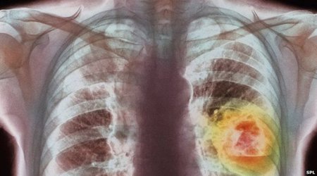 New cancer strategy 'could save thousands'