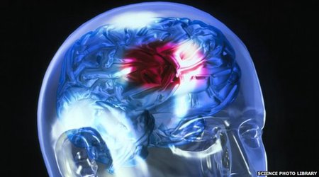 Clot-busting stroke drug safe, says expert review