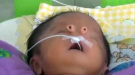 Baby is born with two TUBES on his face instead of a nose