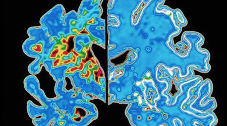 Virtual reality maze 'predicts Alzheimer's disease'
