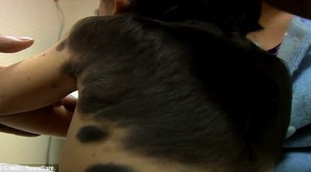 The boy with 'fur' growing on his back