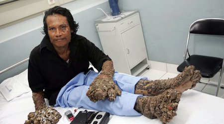 Man who suffered from limbs like TREE TRUNKS dies