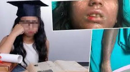 Həkimin yazdığı dərman 15 yaşlı qızcığazı bu hala gətirdi - FOTO