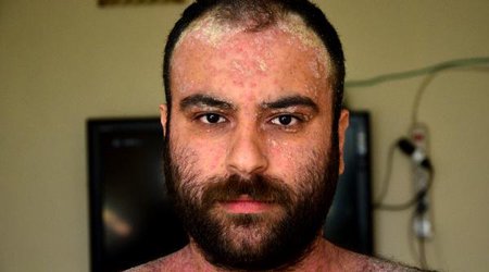 Xəstəliyi səbəbindən evə qapanan gənc - Oturduğu yerə dərisindən qabıqlar tökülür - FOTO