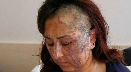 Boşanmaq istəyən arvadını belə yandırdı - FOTO