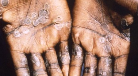 Portugal reports 14 new cases of monkeypox infection