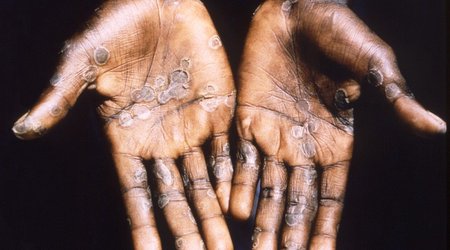 Morocco reports first monkeypox case