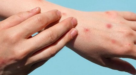 Turkiye records first case of monkeypox