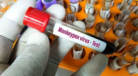 WHO provides monkeypox test kits to Azerbaijan