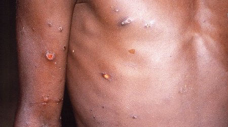 India confirms first monkeypox death